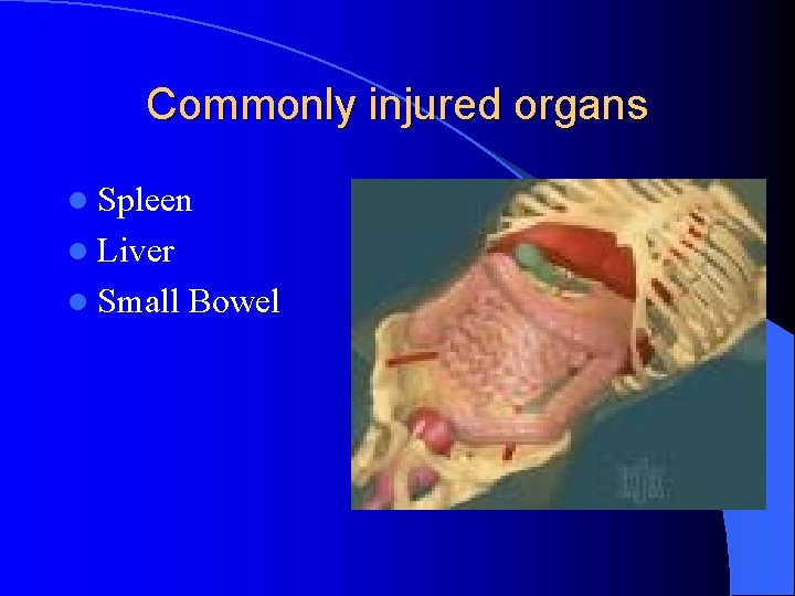 Commonly injured organs l Spleen l Liver l Small Bowel Commonly injured organs l Spleen l Liver l Small Bowel