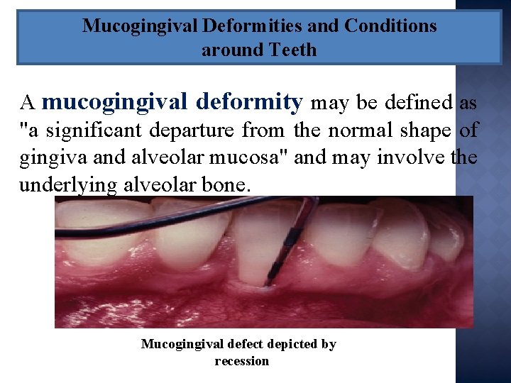 Mucogingival Deformities and Conditions around Teeth A mucogingival deformity may be defined as "a