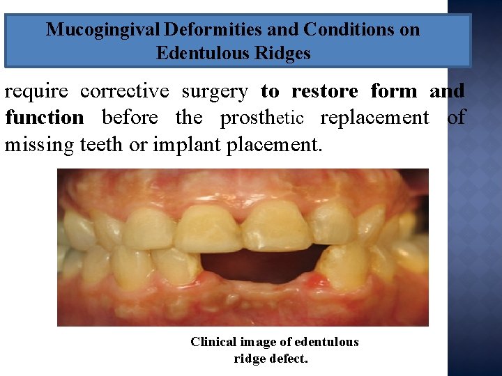 Mucogingival Deformities and Conditions on Edentulous Ridges require corrective surgery to restore form and