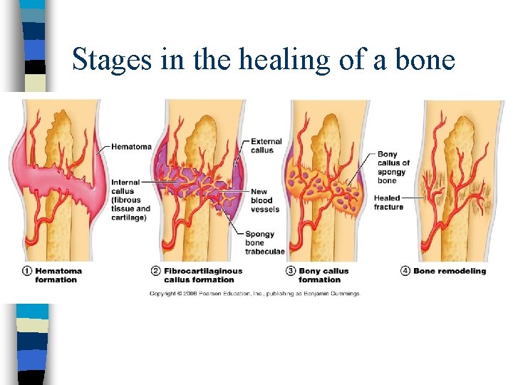 Stages in the healing of a bone 
