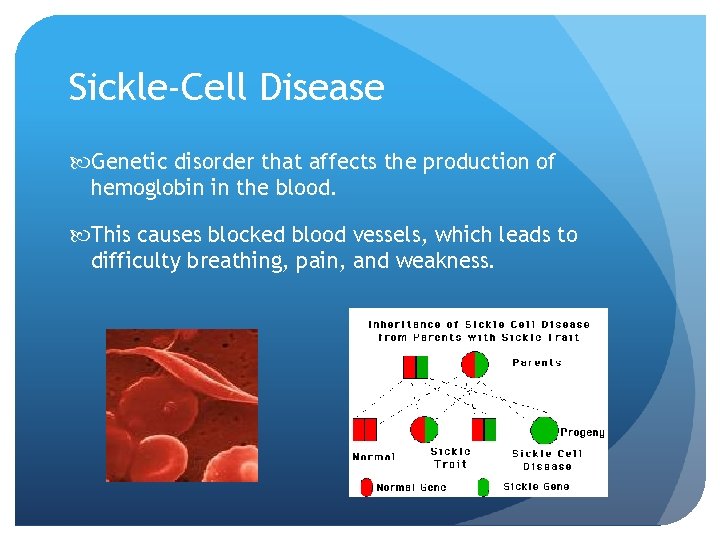 Sickle-Cell Disease Genetic disorder that affects the production of hemoglobin in the blood. This