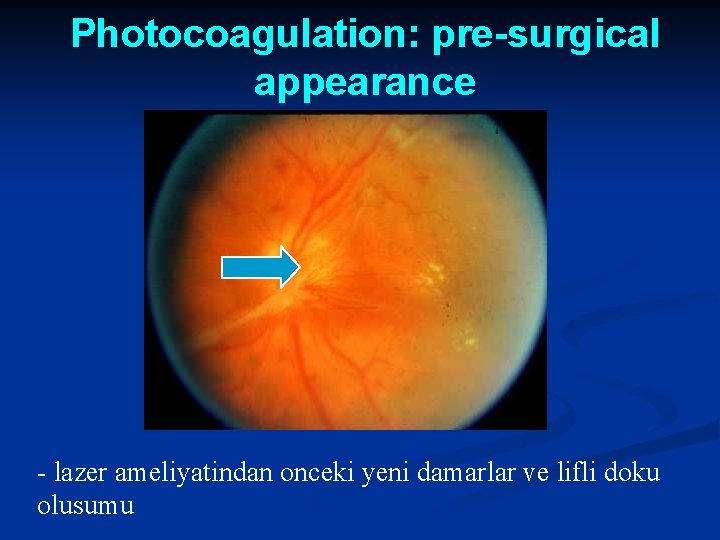 Photocoagulation: pre-surgical appearance - lazer ameliyatindan onceki yeni damarlar ve lifli doku olusumu 