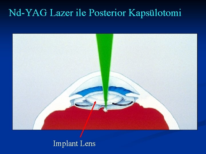 Nd-YAG Lazer ile Posterior Kapsülotomi Implant Lens 