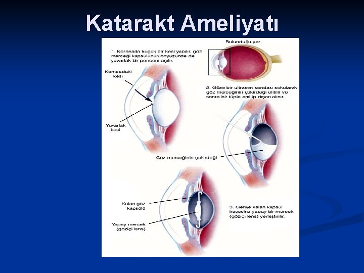 Katarakt Ameliyatı 