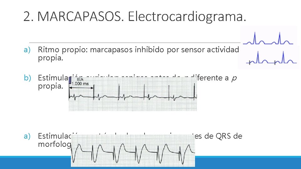2. MARCAPASOS. Electrocardiograma. a) Ritmo propio: marcapasos inhibido por sensor actividad propia. b) Estimulación