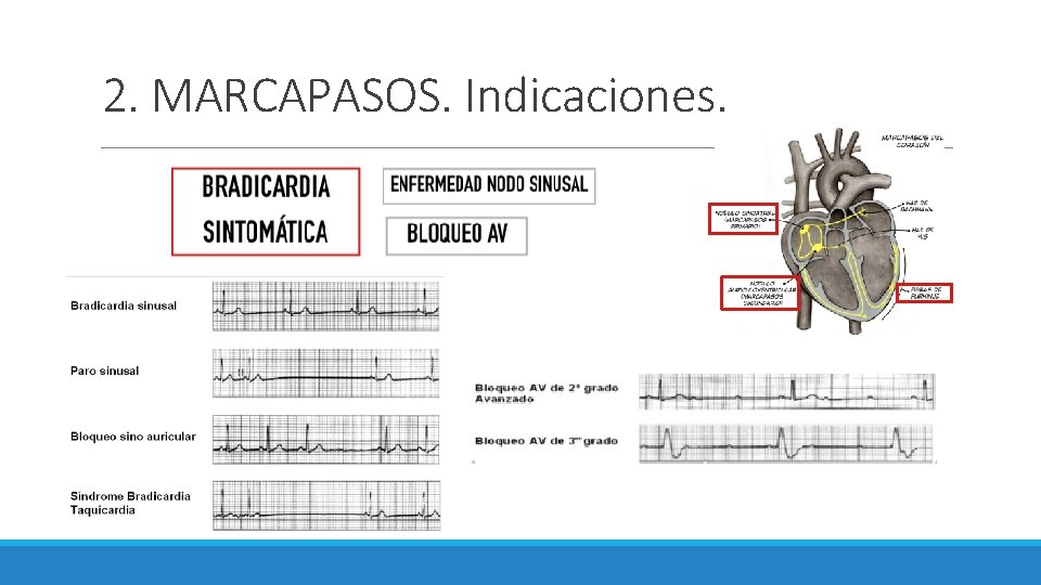 2. MARCAPASOS. Indicaciones. 