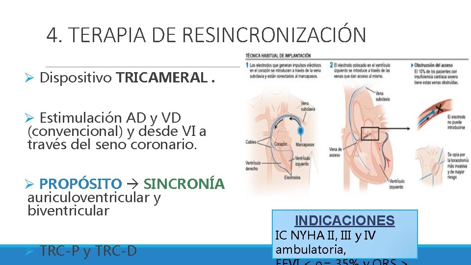 4. TERAPIA DE RESINCRONIZACIÓN Ø Dispositivo TRICAMERAL. Ø Estimulación AD y VD (convencional) y