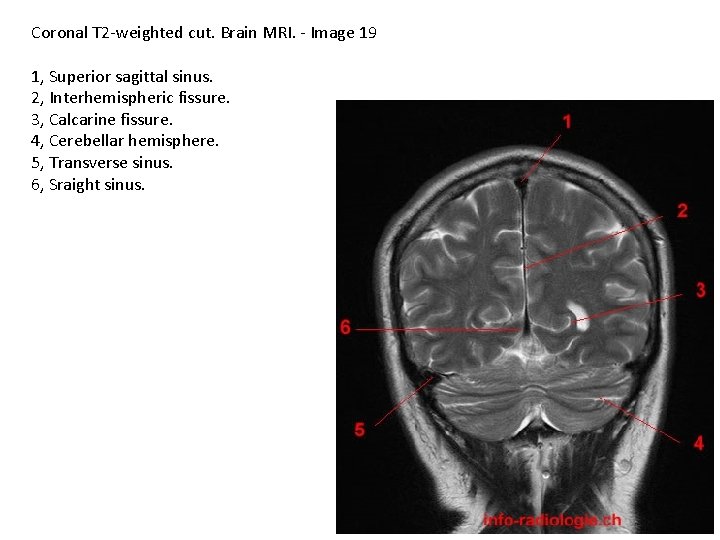 Coronal T 2 -weighted cut. Brain MRI. - Image 19 1, Superior sagittal sinus.