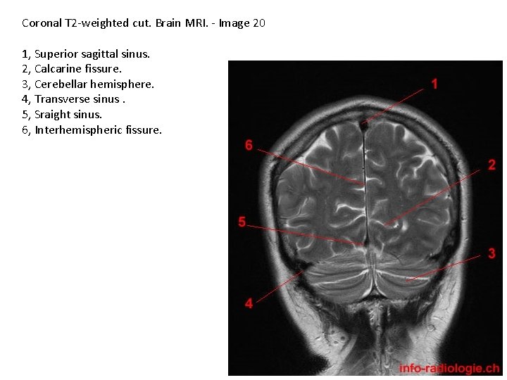 Coronal T 2 -weighted cut. Brain MRI. - Image 20 1, Superior sagittal sinus.