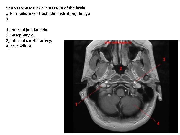 Venous sinuses: axial cuts (MRI of the brain after medium contrast administration). Image 1