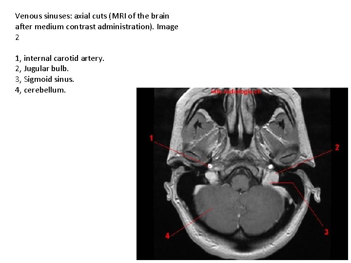 Venous sinuses: axial cuts (MRI of the brain after medium contrast administration). Image 2