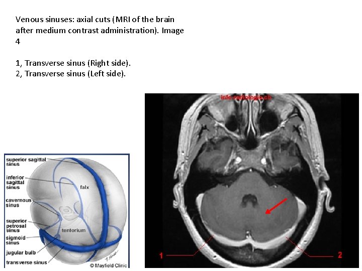 Venous sinuses: axial cuts (MRI of the brain after medium contrast administration). Image 4