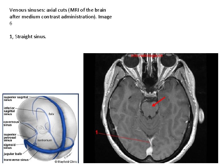 Venous sinuses: axial cuts (MRI of the brain after medium contrast administration). Image 6