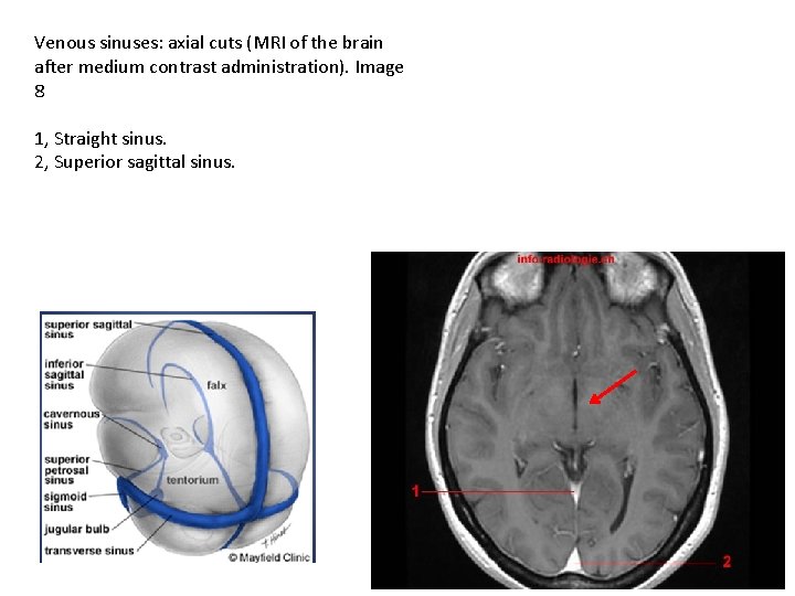 Venous sinuses: axial cuts (MRI of the brain after medium contrast administration). Image 8