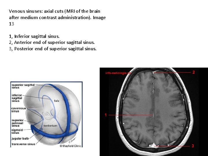 Venous sinuses: axial cuts (MRI of the brain after medium contrast administration). Image 13
