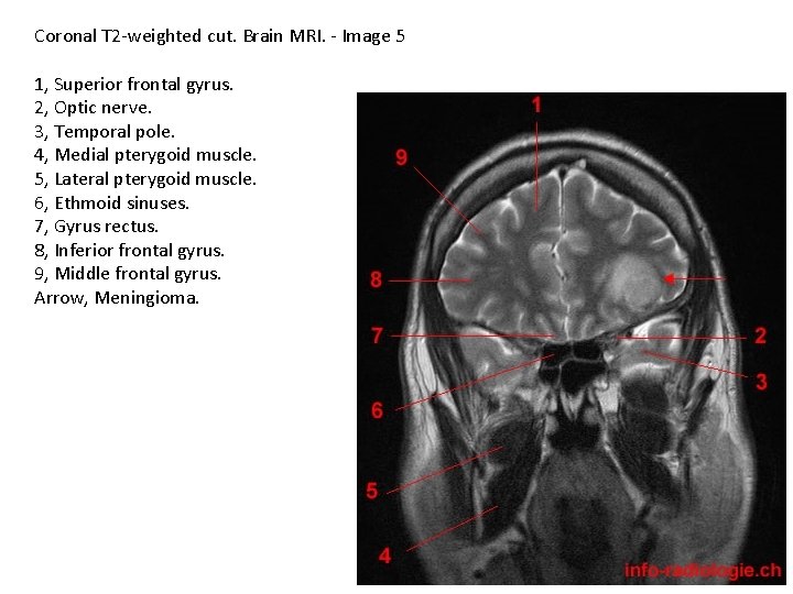 Coronal T 2 -weighted cut. Brain MRI. - Image 5 1, Superior frontal gyrus.