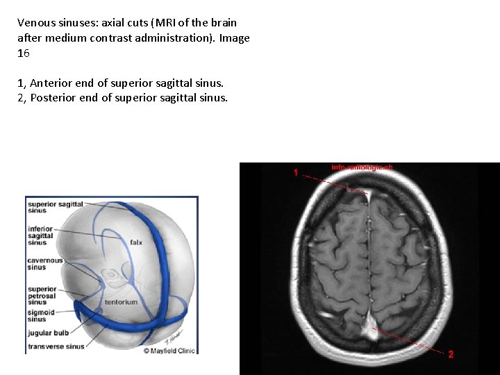 Venous sinuses: axial cuts (MRI of the brain after medium contrast administration). Image 16