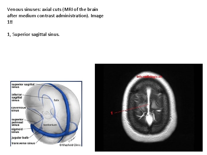 Venous sinuses: axial cuts (MRI of the brain after medium contrast administration). Image 18