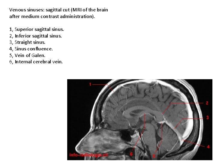 Venous sinuses: sagittal cut (MRI of the brain after medium contrast administration). 1, Superior