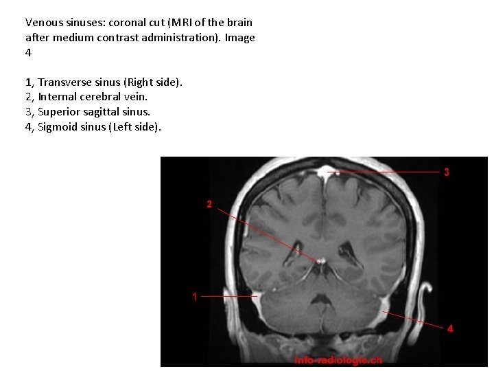 Venous sinuses: coronal cut (MRI of the brain after medium contrast administration). Image 4