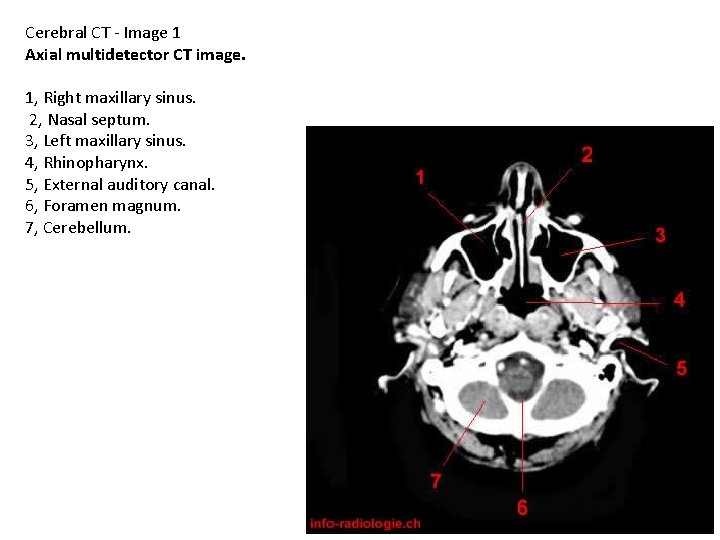 Cerebral CT - Image 1 Axial multidetector CT image. 1, Right maxillary sinus. 2,