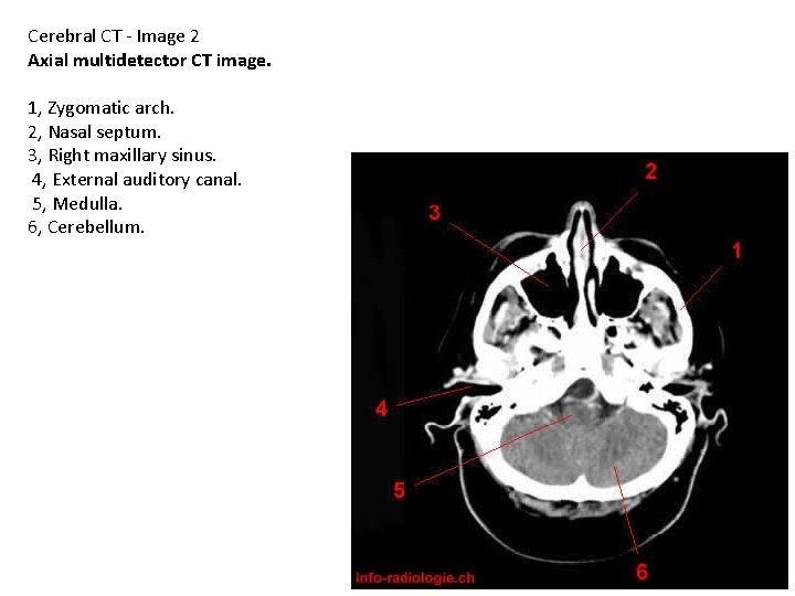 Cerebral CT - Image 2 Axial multidetector CT image. 1, Zygomatic arch. 2, Nasal