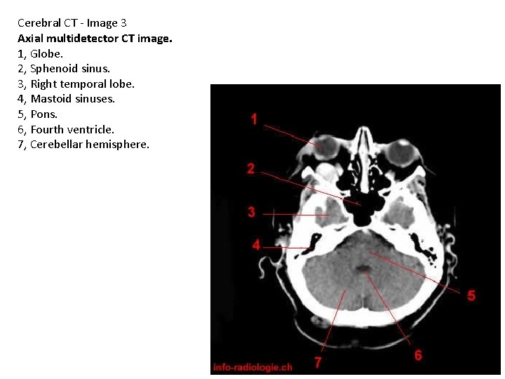 Cerebral CT - Image 3 Axial multidetector CT image. 1, Globe. 2, Sphenoid sinus.