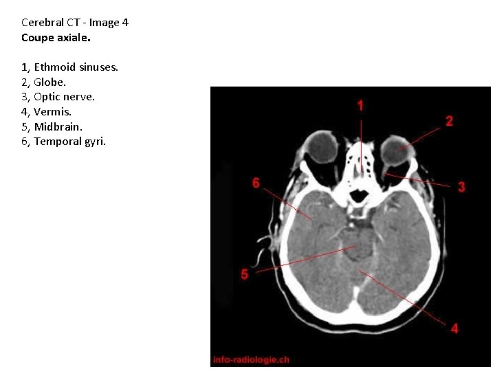 Cerebral CT - Image 4 Coupe axiale. 1, Ethmoid sinuses. 2, Globe. 3, Optic
