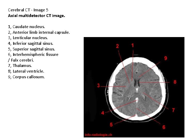 Cerebral CT - Image 5 Axial multidetector CT image. 1, Caudate nucleus. 2, Anterior