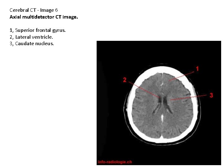 Cerebral CT - Image 6 Axial multidetector CT image. 1, Superior frontal gyrus. 2,