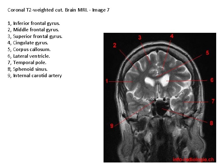 Coronal T 2 -weighted cut. Brain MRI. - Image 7 1, Inferior frontal gyrus.