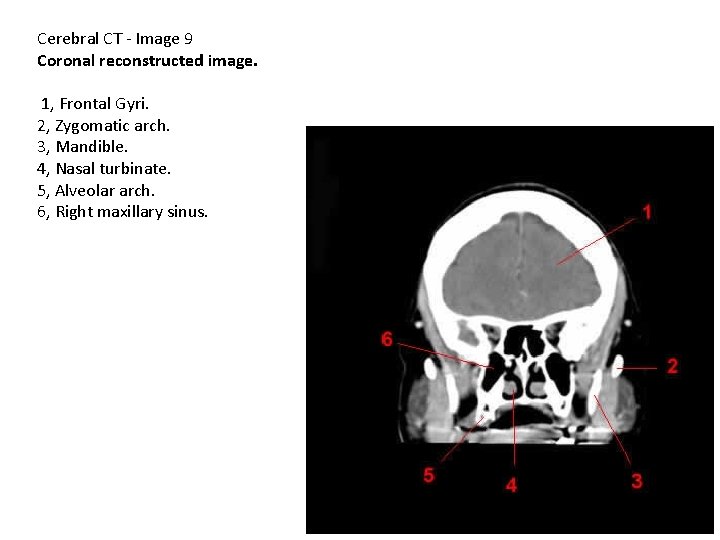 Cerebral CT - Image 9 Coronal reconstructed image. 1, Frontal Gyri. 2, Zygomatic arch.