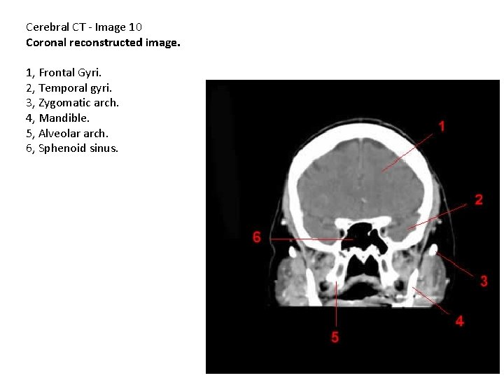 Cerebral CT - Image 10 Coronal reconstructed image. 1, Frontal Gyri. 2, Temporal gyri.