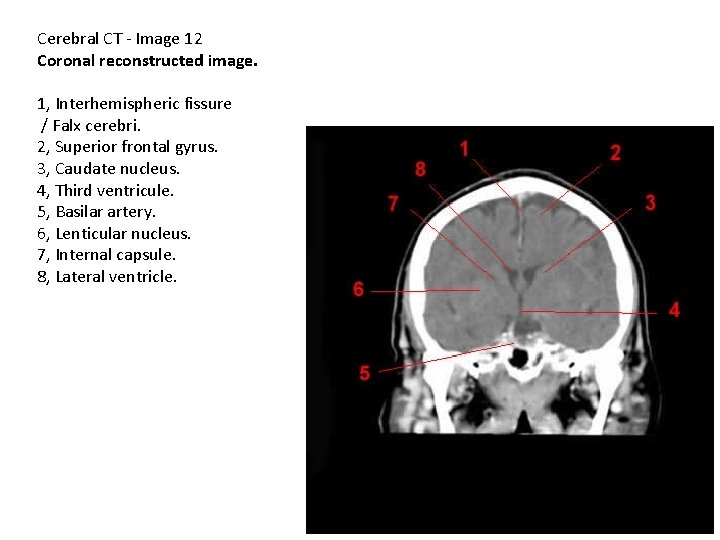 Cerebral CT - Image 12 Coronal reconstructed image. 1, Interhemispheric fissure / Falx cerebri.