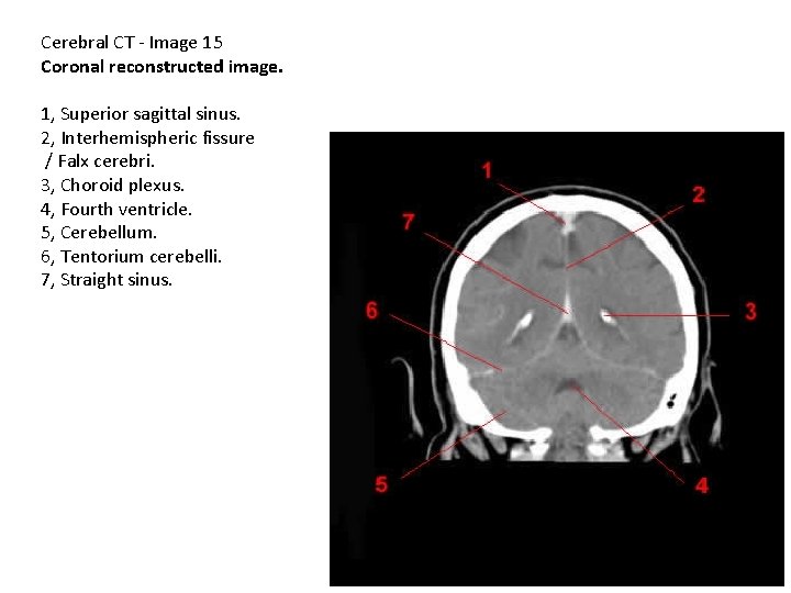 Cerebral CT - Image 15 Coronal reconstructed image. 1, Superior sagittal sinus. 2, Interhemispheric