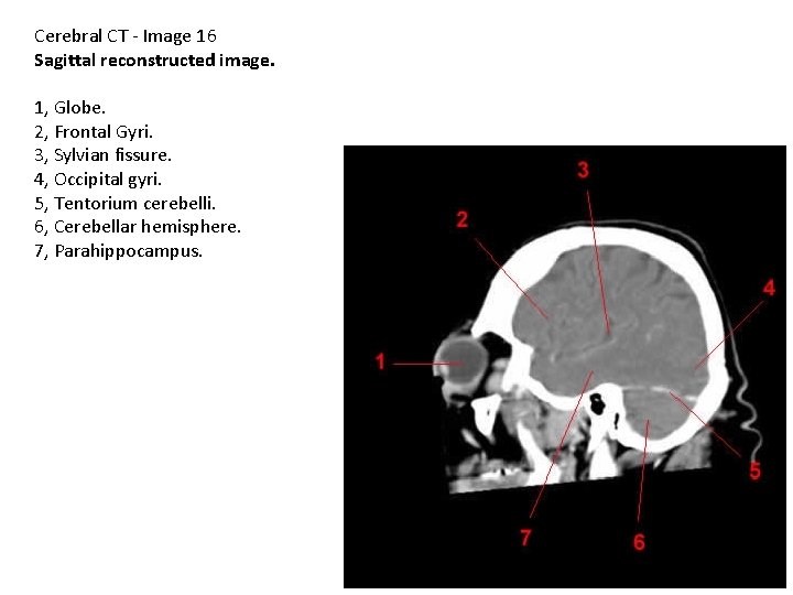 Cerebral CT - Image 16 Sagittal reconstructed image. 1, Globe. 2, Frontal Gyri. 3,