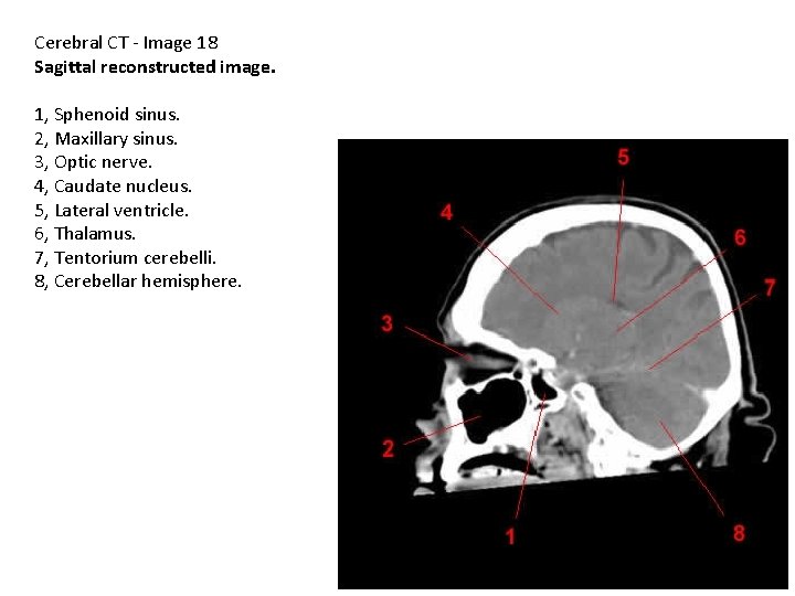 Cerebral CT - Image 18 Sagittal reconstructed image. 1, Sphenoid sinus. 2, Maxillary sinus.