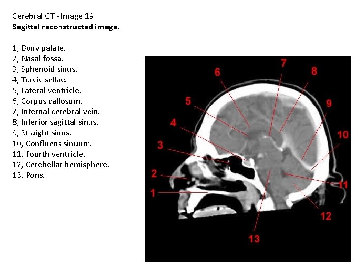 Cerebral CT - Image 19 Sagittal reconstructed image. 1, Bony palate. 2, Nasal fossa.