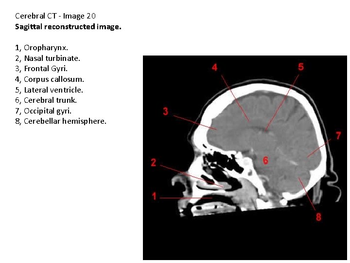 Cerebral CT - Image 20 Sagittal reconstructed image. 1, Oropharynx. 2, Nasal turbinate. 3,