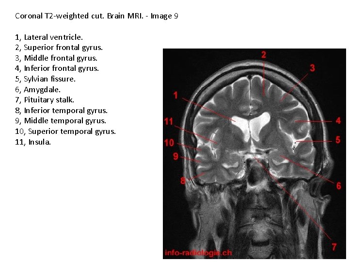 Coronal T 2 -weighted cut. Brain MRI. - Image 9 1, Lateral ventricle. 2,
