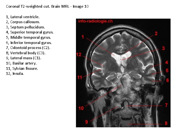 Coronal T 2 -weighted cut. Brain MRI. - Image 10 1, Lateral ventricle. 2,