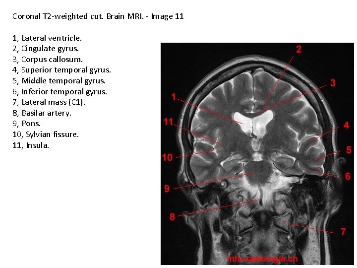 Coronal T 2 -weighted cut. Brain MRI. - Image 11 1, Lateral ventricle. 2,