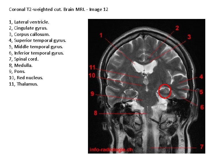 Coronal T 2 -weighted cut. Brain MRI. - Image 12 1, Lateral ventricle. 2,