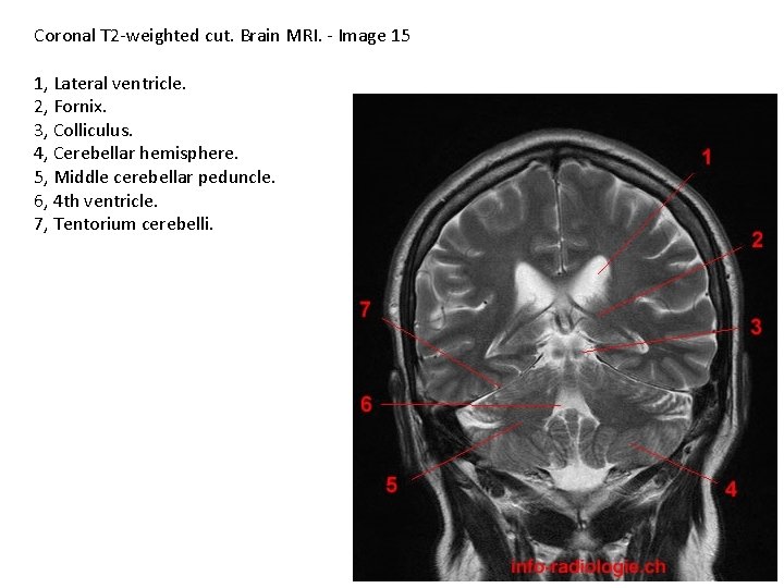 Coronal T 2 -weighted cut. Brain MRI. - Image 15 1, Lateral ventricle. 2,