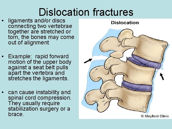 Dislocation fractures • ligaments and/or discs connecting two vertebrae together are stretched or torn,