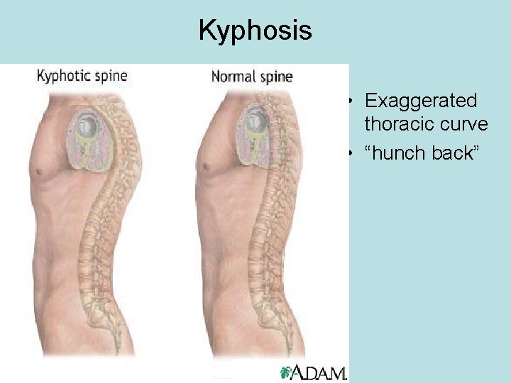 Kyphosis • Exaggerated thoracic curve • “hunch back” 