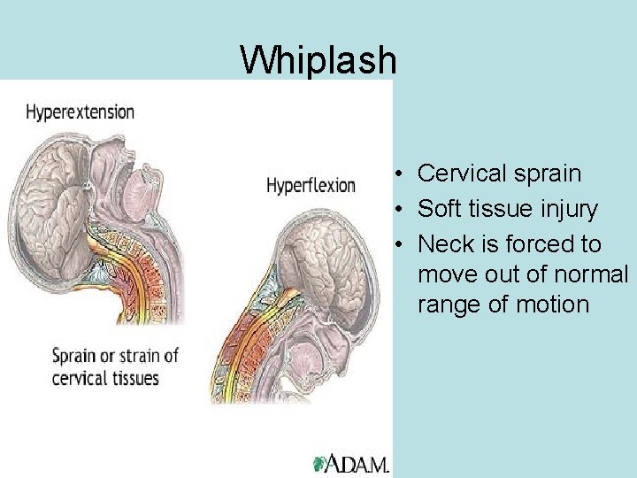Whiplash • Cervical sprain • Soft tissue injury • Neck is forced to move