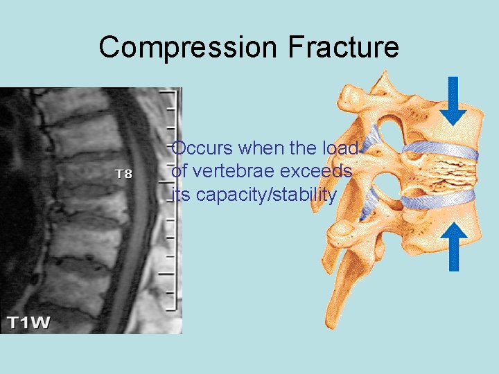 Compression Fracture Occurs when the load of vertebrae exceeds its capacity/stability 