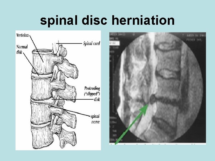 spinal disc herniation 