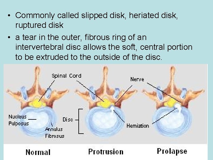  • Commonly called slipped disk, heriated disk, ruptured disk • a tear in
